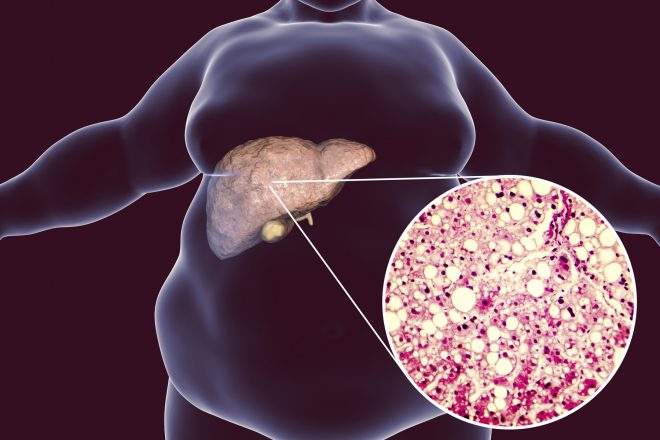 Testosterone therapy may reduce non-alcoholic fatty liver disease in obese