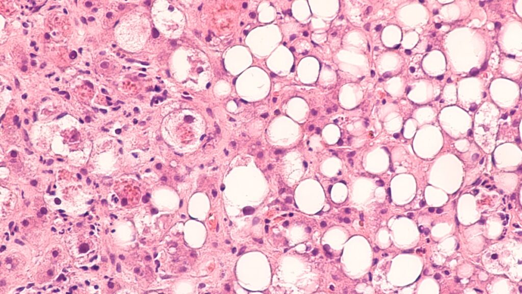 Antibody-targeted immunotoxins could help treat liver fibrosis