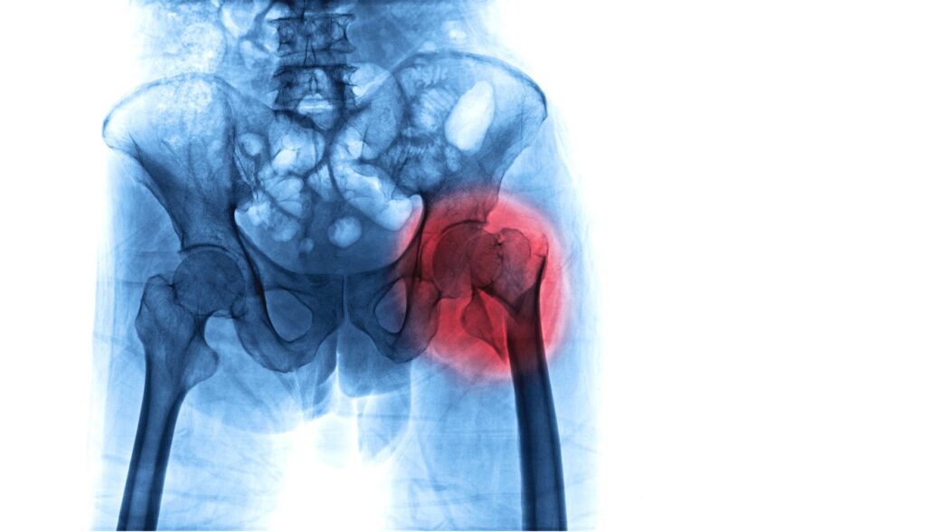 Spinal and general anesthesia associated with similar outcomes in hip-fracture surgery