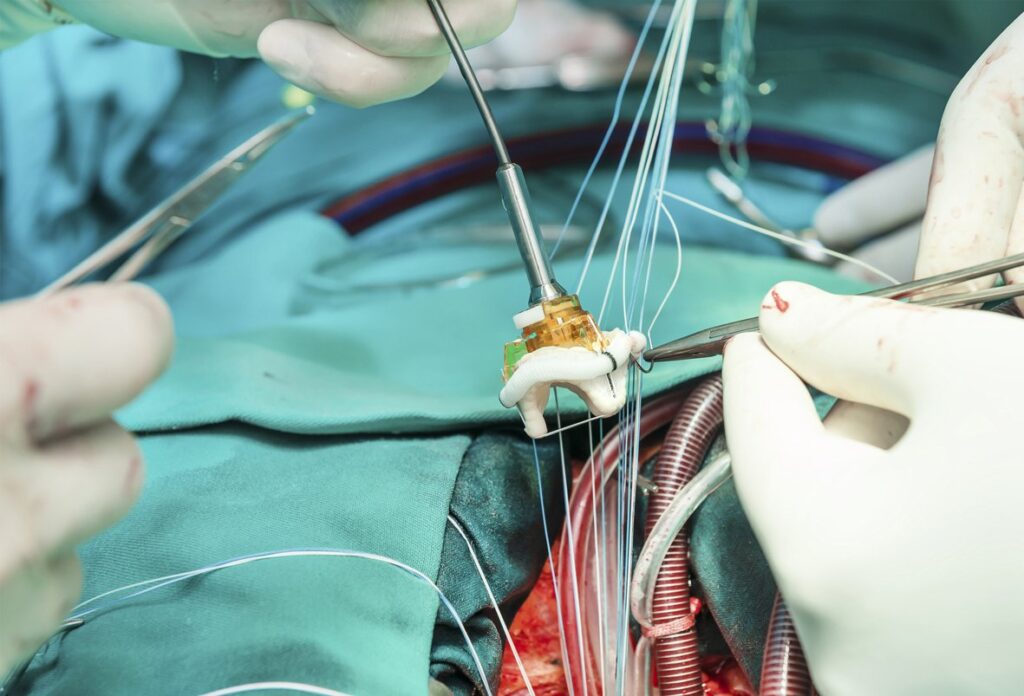 AHA 2021: Early heart valve surgery could benefit asymptomatic severe aortic stenosis patients