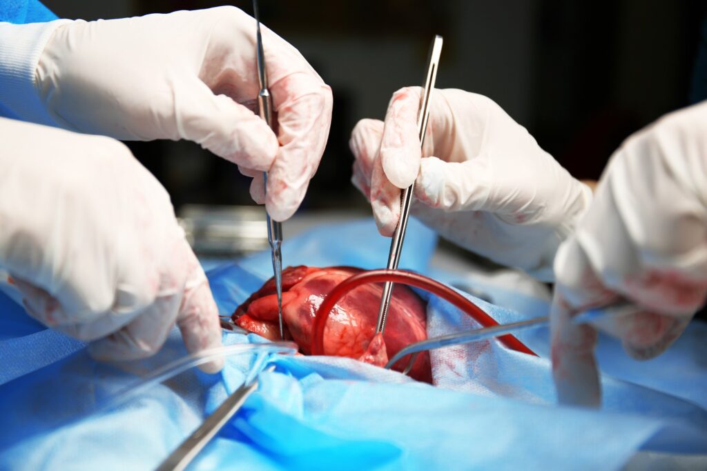 Successful transplant of porcine heart into adult human with end-stage heart disease
