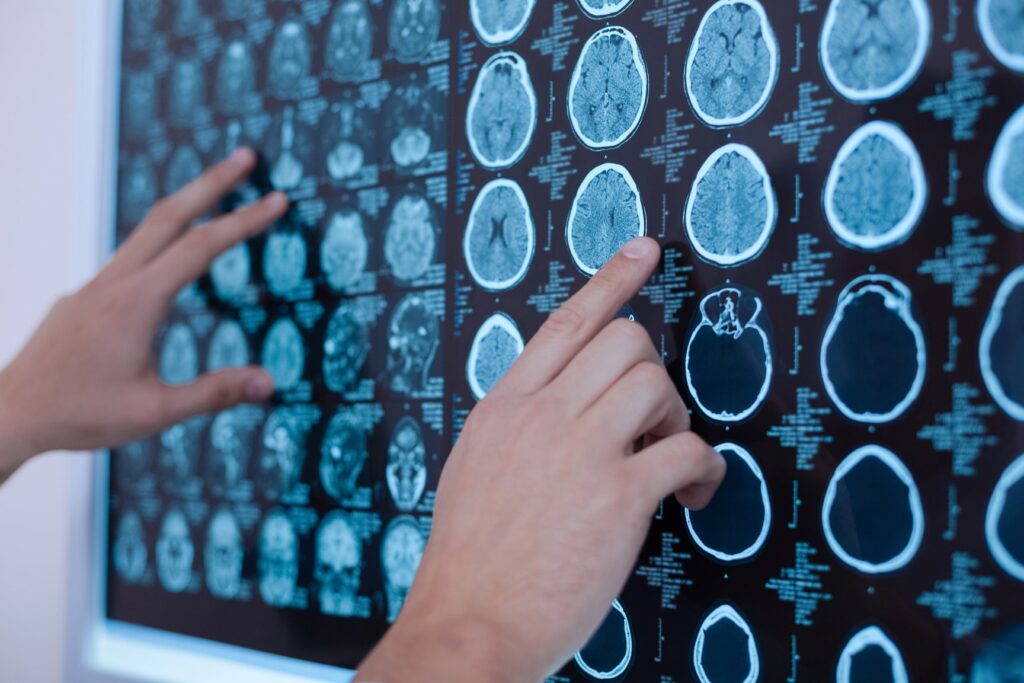 Largest genetic study of migraine to date reveals new genetic risk factors