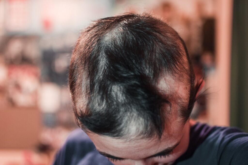 Covid vaccination linked to hair loss