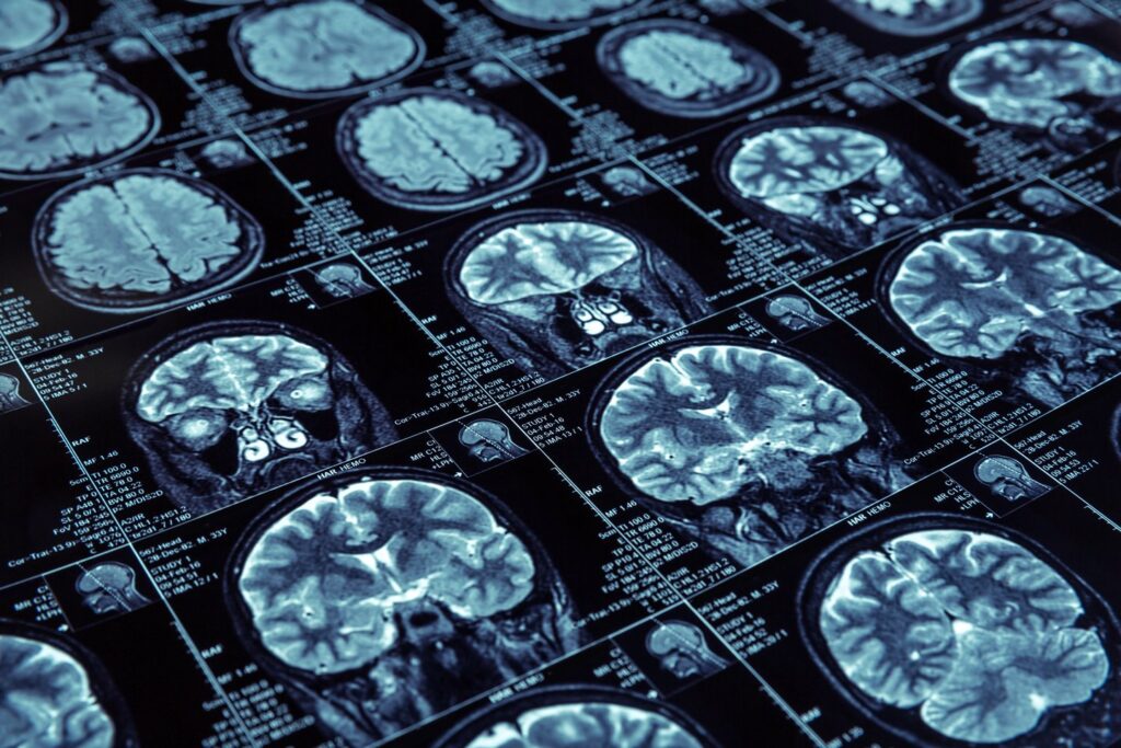 Team uses MRI to image epigenetics in the brain