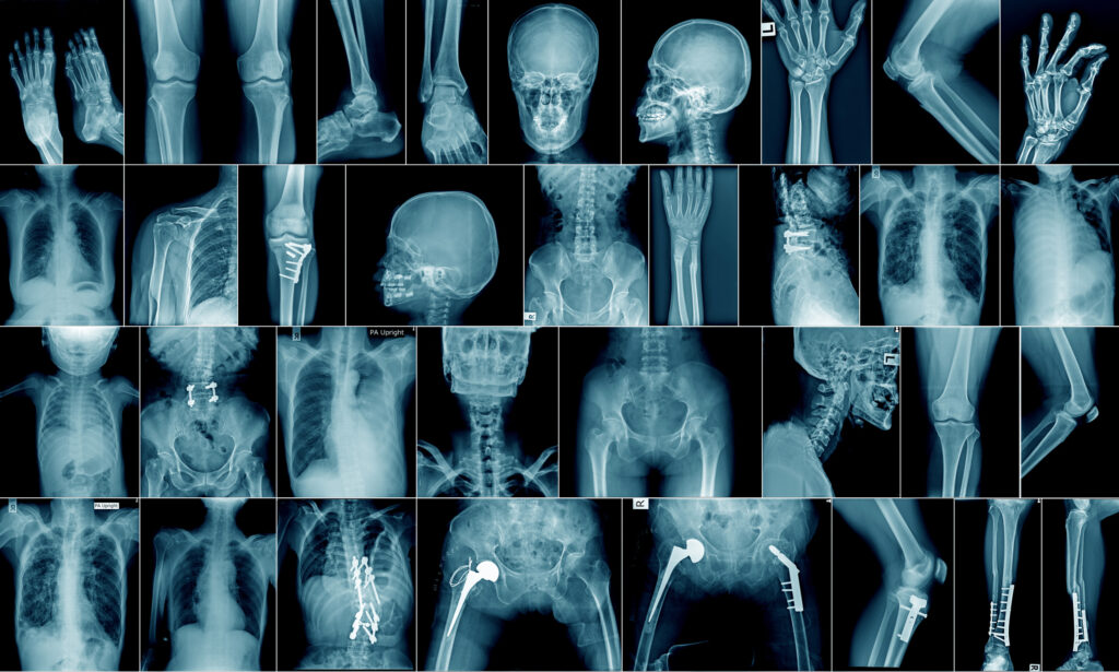 AI helps radiologists detect bone fractures