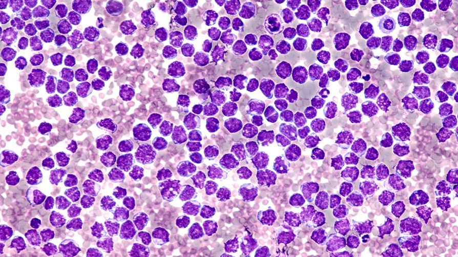 Improved treatment emerges for mantle cell lymphoma