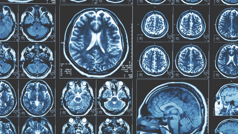 Single brain scan can diagnose Alzheimer’s disease