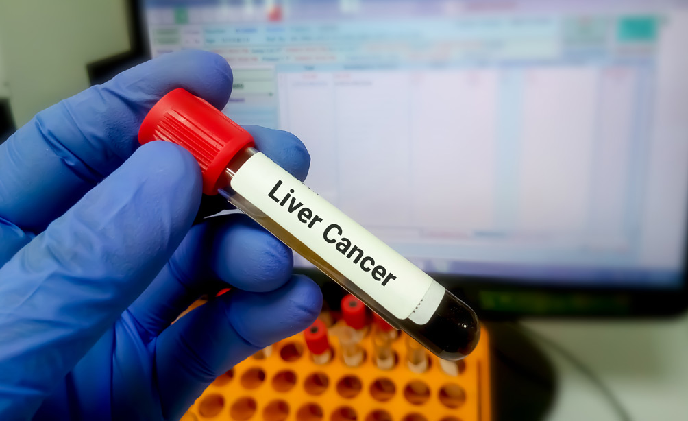 Novel AI blood test detects liver cancer