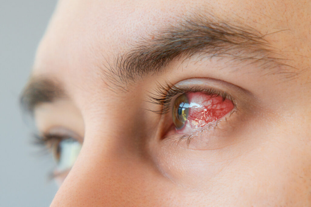 Dry eye disease alters how the eye’s cornea heals itself after injury