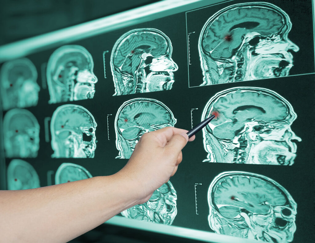 Is bone health linked to brain health?