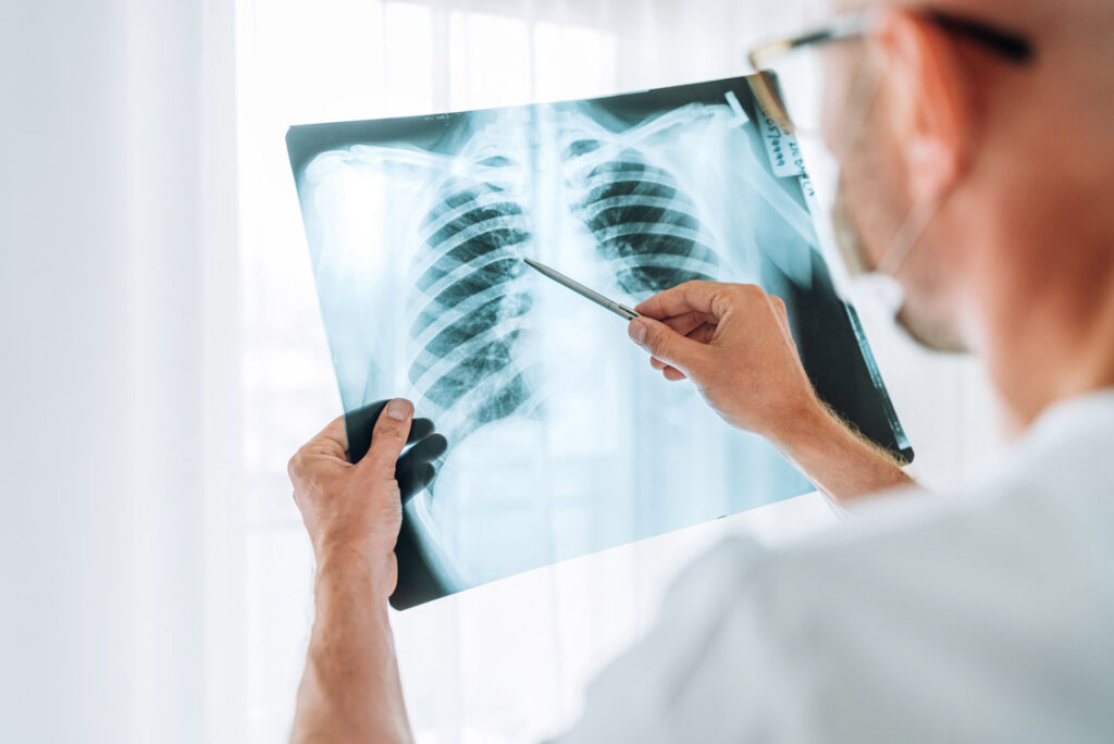 AI software at least as good as radiologists at detecting TB from chest X-rays