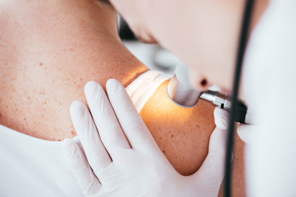 Study shows promising results for immunotherapy targeting skin cancer