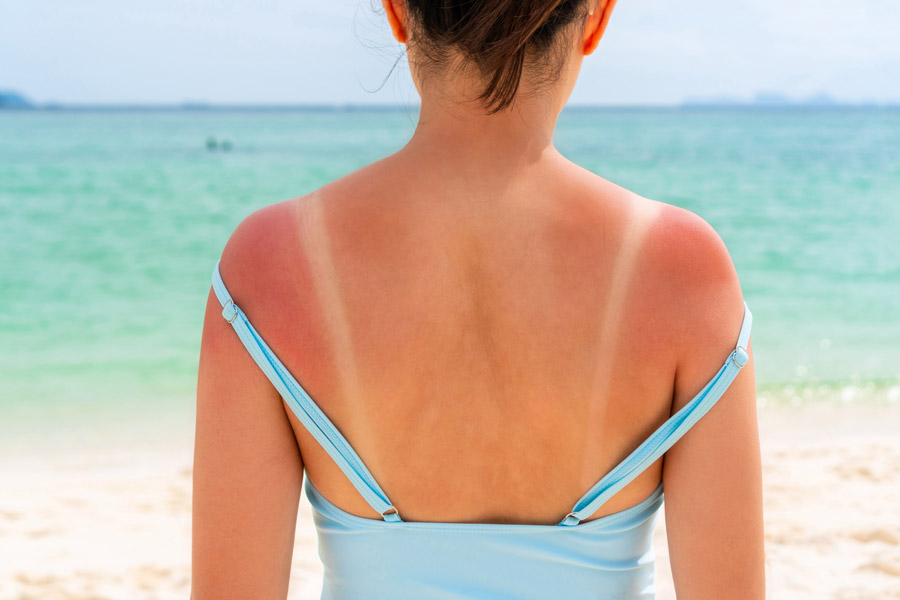 Holidaymakers be warned: Short, intense sun-seeking trips can disrupt skin’s microbiome