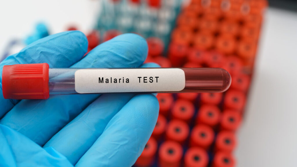 Scientists find ‘concerning’ flaw in malaria diagnostics