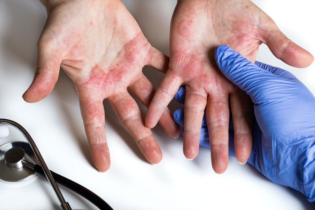 Atopic dermatitis: Viruses discovered as new therapy option